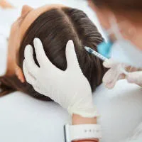 Zabieg mezoterapii skóry głowy przeciw wypadaniu włosów w gabinecie Prestige Laser we Wrocławiu