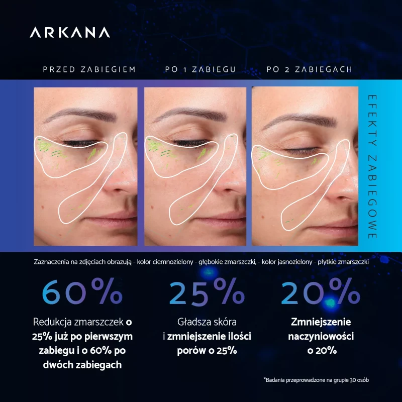 Porównanie efektów zabiegów Arkana z egzosomami – zdjęcia skóry twarzy przed kuracją, po jednym oraz po dwóch zabiegach wykonanych w gabinecie Prestige Laser we Wrocławiu.