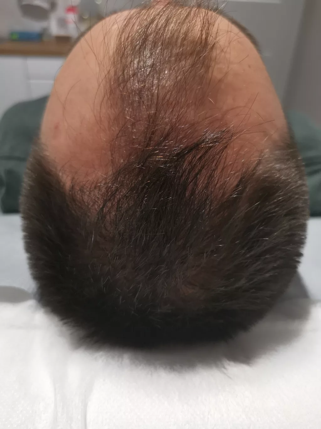 Zdjęcie skóry głowy mężczyzny po zakończeniu terapii przeciw wypadaniu włosów z użyciem preparatu Dr.CYJ Hair Filler w gabinecie Prestige Laser Kosmetologia Estetyczna we Wrocławiu – widoczne zagęszczenie włosów.