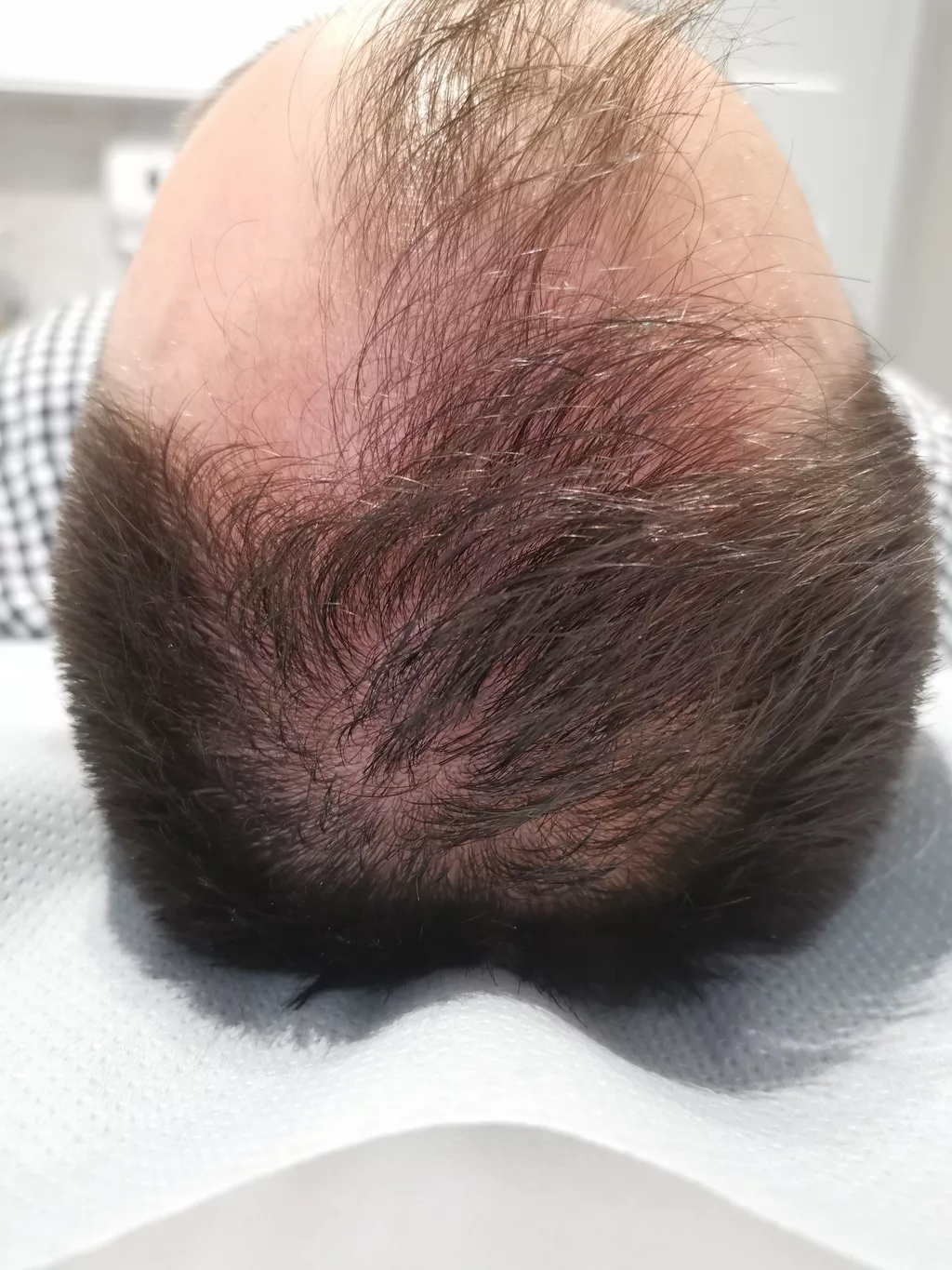 Zdjęcie skóry głowy mężczyzny przed rozpoczęciem terapii przeciw wypadaniu włosów z użyciem preparatu Dr.CYJ Hair Filler w gabinecie Prestige Laser Kosmetologia Estetyczna we Wrocławiu.
