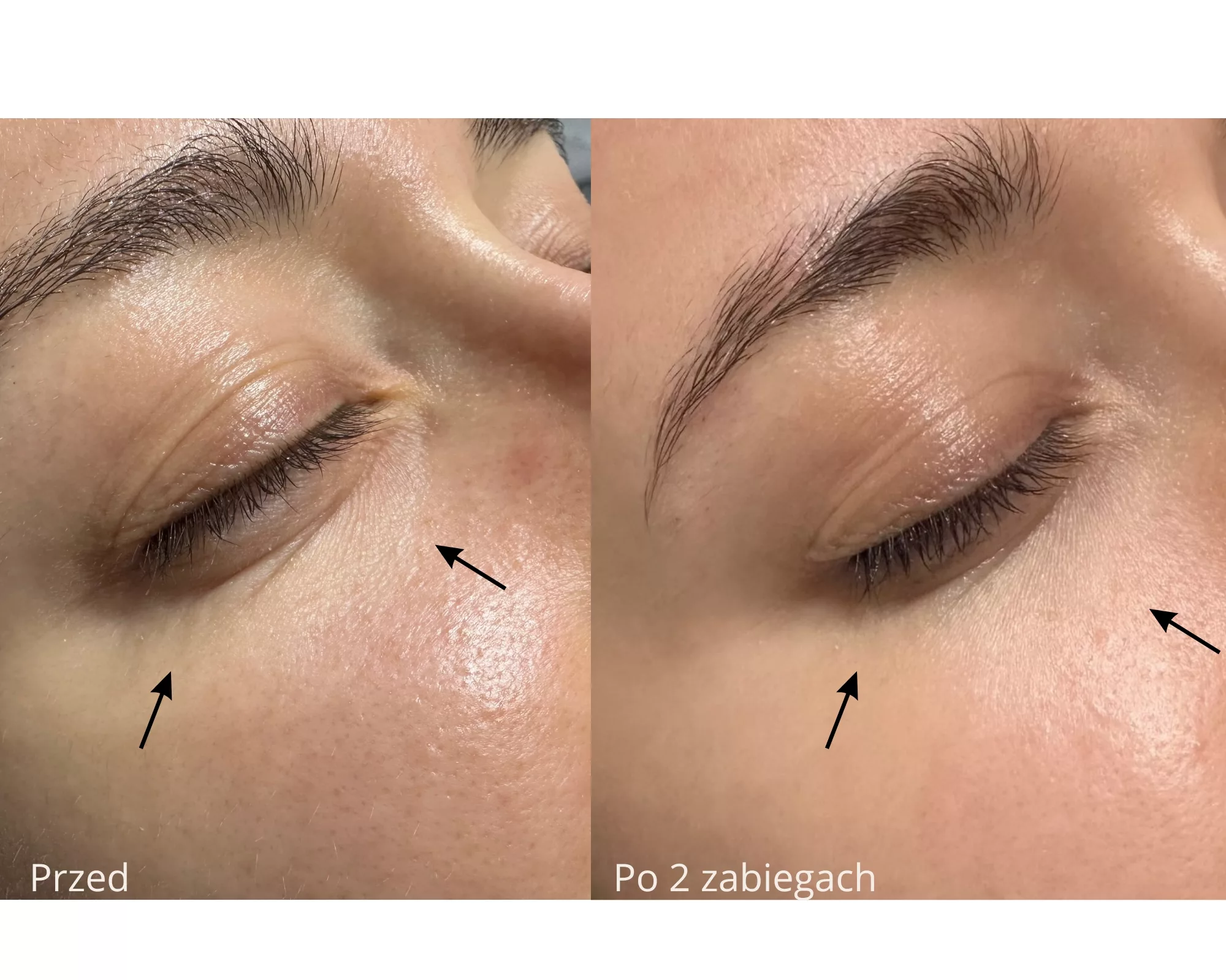 Porównanie skóry wokół oczu przed i po dwóch zabiegach z użyciem preparatu z polinukleotydami wykonanych w gabinecie Prestige Laser Kosmetologia Estetyczna we Wrocławiu.