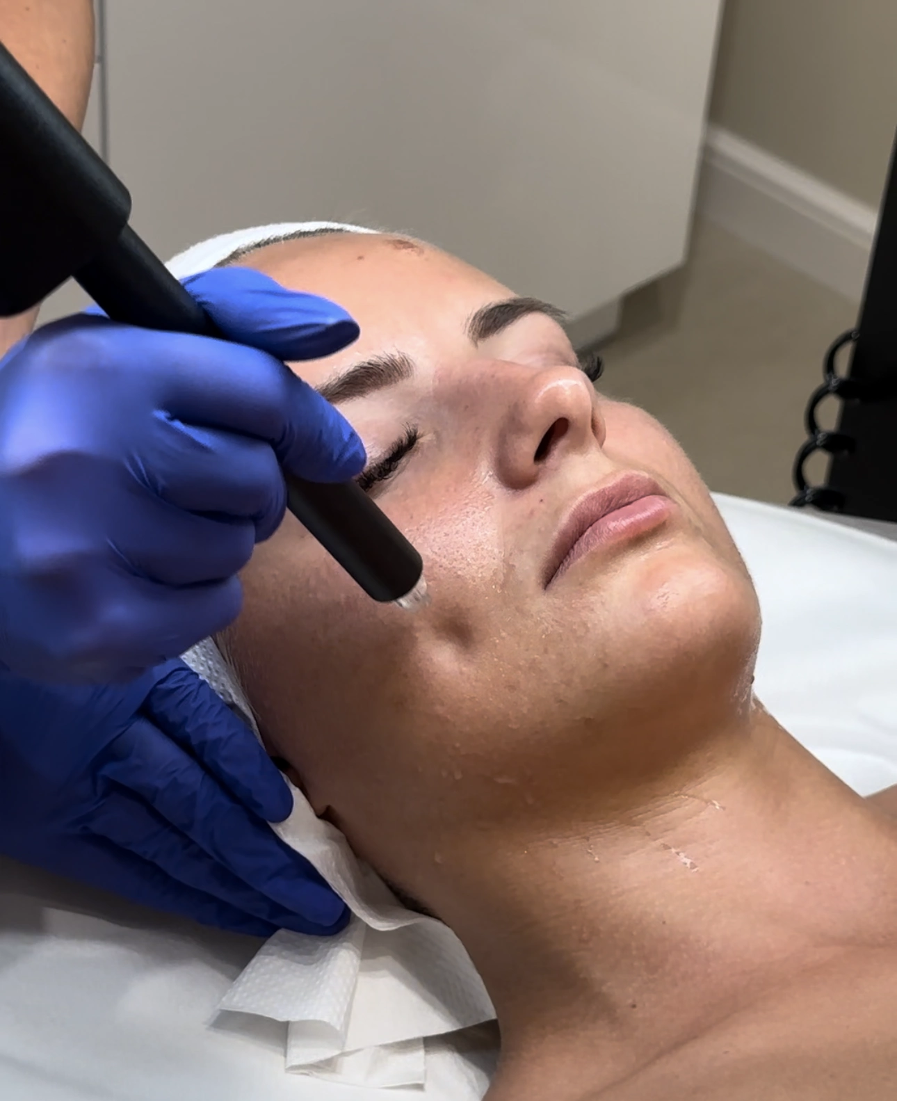 Zabieg Radiofrekwencji Mikroigłowej w salonie kosmetycznym Prestige Laser we wrocławiu