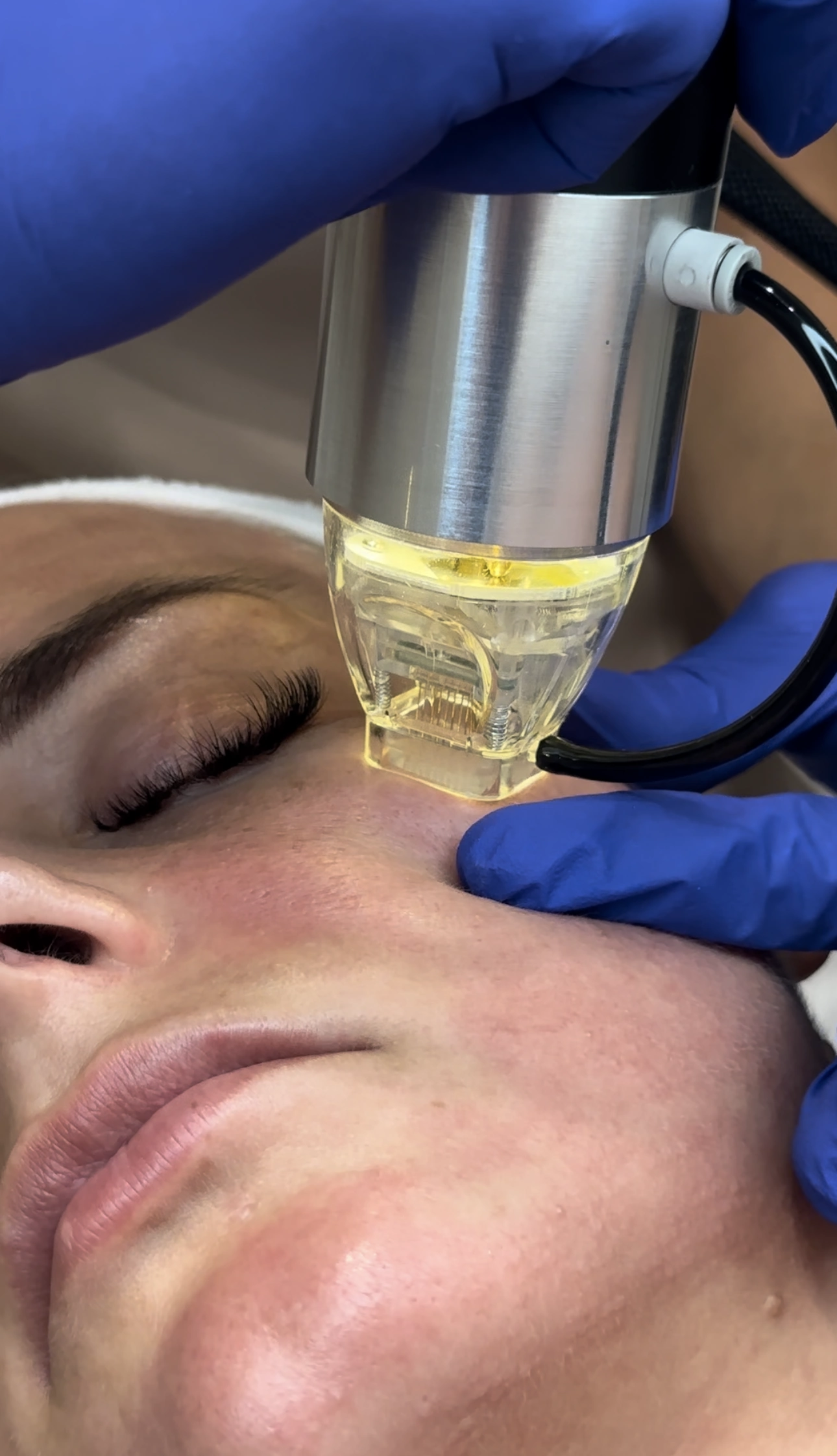 Zabieg Radiofrekwencji Mikroigłowej w salonie kosmetycznym Prestige Laser we wrocławiu