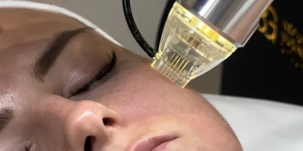 Zabieg radiofrekwencji mikroigłowej w Prestige Laser Kosmetologia Estetyczna Wrocław – salon kosmetyczny oferujący lifting skóry i redukcję zmarszczek przy użyciu nowoczesnej technologii RF we Wrocławiu.