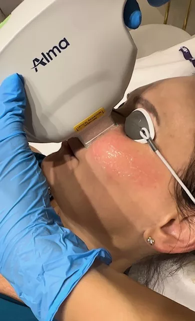 Zabieg fotoodmładzania Alma w Prestige Laser Kosmetologia Estetyczna Wrocław – salon kosmetyczny, specjalistyczna pielęgnacja skóry twarzy przy użyciu nowoczesnego lasera.