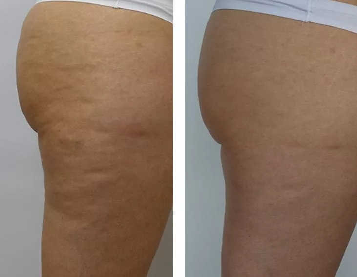 Porównanie wyglądu pośladków i ud kobiety po serii zabiegów Endermologia Wrocław w salonie Prestige Laser Kosmetologia Estetyczna. Widoczne rezultaty w modelowaniu sylwetki i redukcji cellulitu