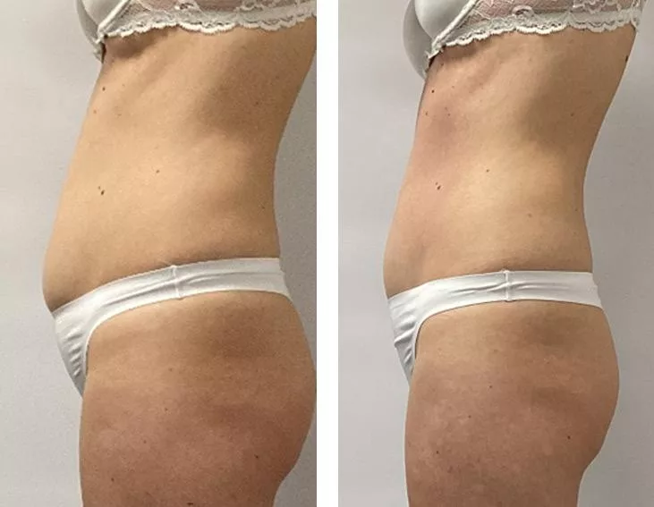 Porównanie sylwetki kobiety po zabiegach endermologii w salonie Prestige Laser Kosmetologia Estetyczna Wrocław
