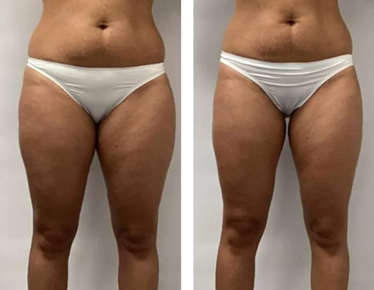 Porównanie sylwetki kobiety przed i po serii zabiegów Endermologia Wrocław, pokazujące widoczne zmiany w obrębie brzucha i ud.