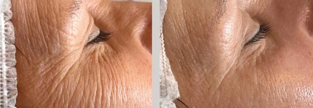 Zbliżenie twarzy starszej osoby przed i po zabiegu endermologii w salonie Prestige Laser we Wrocławiu