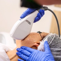 zbliżenie na twarz pacjentki podczas zabiegu laserowej redukcji rumienia w Prestige Laser Kosmetologia Estetyczna Wrocław