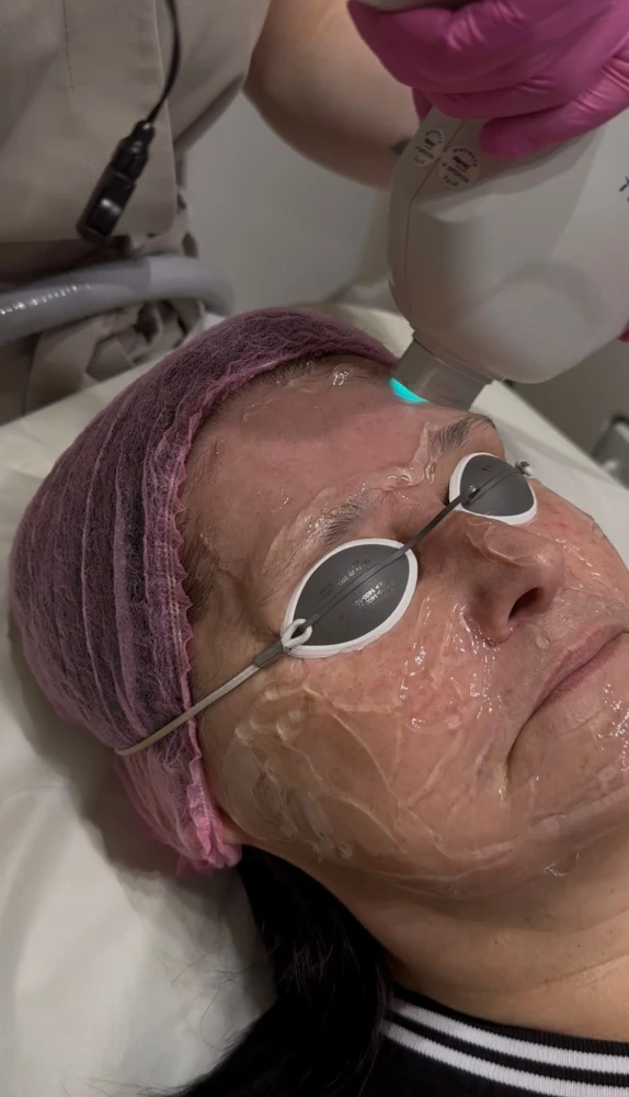 Laserowe fotoodmładzanie czoła urządzeniem Alma Harmony w salonie Prestige Laser